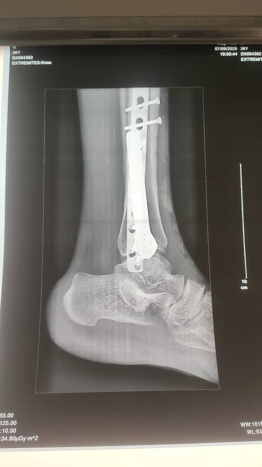 Cheville — post-op