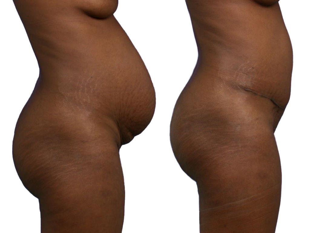 Abdominoplastie
